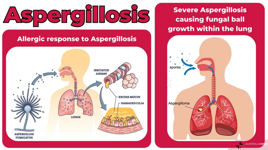 Aspergillosis effects on lungs